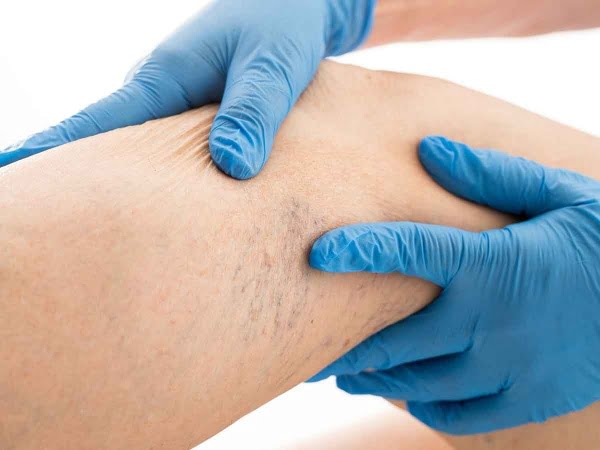  Skleroterapi (Köpük Tedavisi)